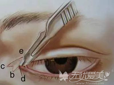 开内眼角手术