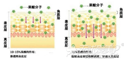 果酸换肤原理