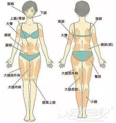 轮廓针可以减脂的部位 轮廓针可以减脂的部位