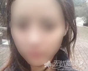 在西安西美做完面部脂肪填充+隆鼻后 我也拥有了少女脸