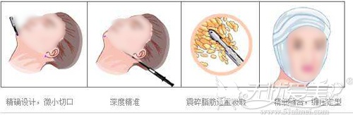 下巴吸脂吸住下颌缘线