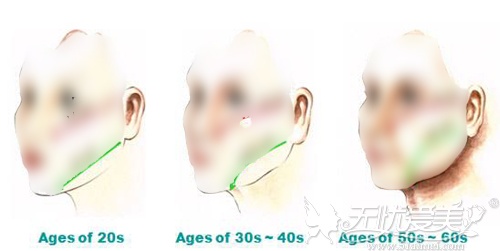 吸脂、瘦脸针、埋线：哪种拯救首批90后消失的下颌线好