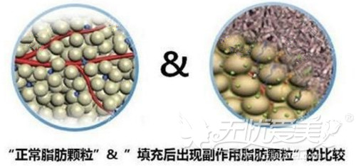 韩国脂肪填充修复术适合的情况