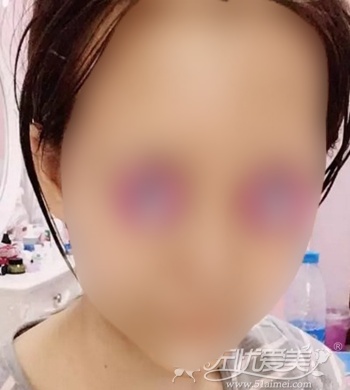 找西安高一生高秀梅医生花35800元做自体脂肪填充全过程