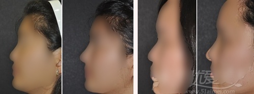 韩国魏亨坤整形专家隆鼻手术案例