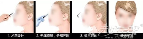 假体隆鼻手术原理