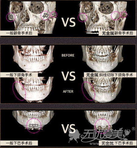 韩国无金属面部轮廓手术过程