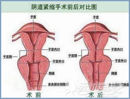 韩式阴道紧缩术后效果