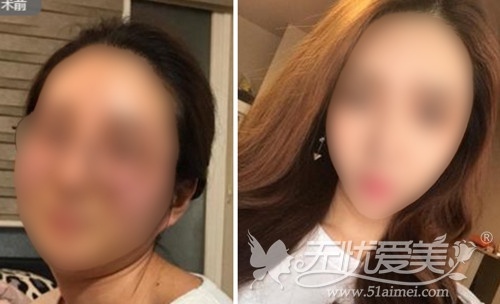 韩国V脸吸脂轮廓术案例