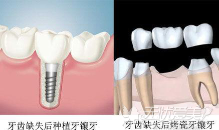 种植牙寿命是多少年？种植牙和镶牙哪个更好？