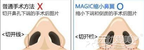 韩国MAGIC鼻翼缩小术切开位置