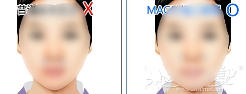 韩国MAGIC鼻翼缩小术 轻松改善宽鼻翼大鼻孔