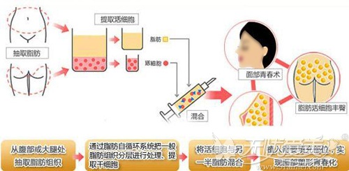 面部自体脂肪填充原理