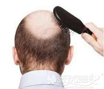 植发时自身毛囊资源不足 能用直系亲属的头发吗?