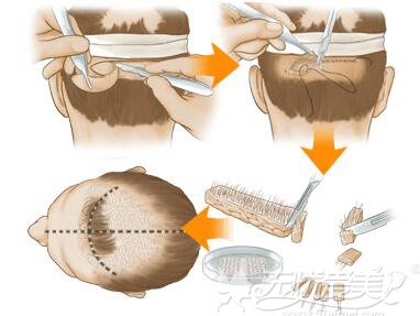 植发原理图图片