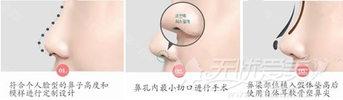 韩国softxil鼻综合新技术 快速拥有美鼻终身无需更换假体