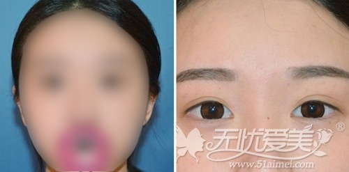 我在深圳江南春天做双眼皮手术+注射隆鼻术前