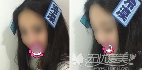 我在深圳江南春天做双眼皮手术+注射隆鼻术后2个月 我在深圳江南春天做双眼皮手术+注射隆鼻术后2个月