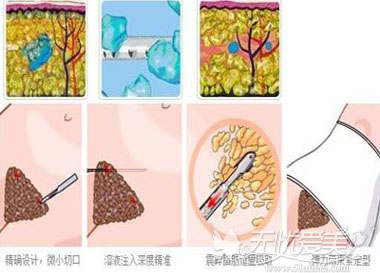 吸脂手术的过程