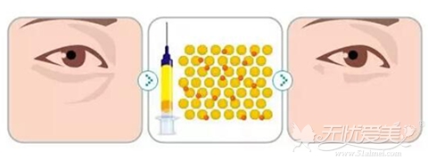 自体脂肪填充泪沟方法