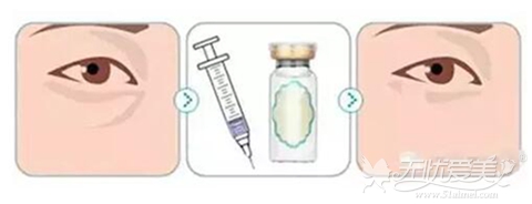 玻尿酸填充泪沟方法