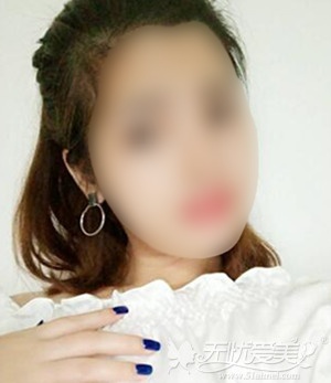 长沙雅美膨体隆鼻整形术后1个月 长沙雅美膨体隆鼻整形术后1个月