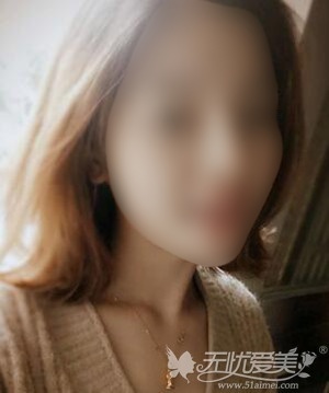 长沙雅美膨体隆鼻整形术后2个月