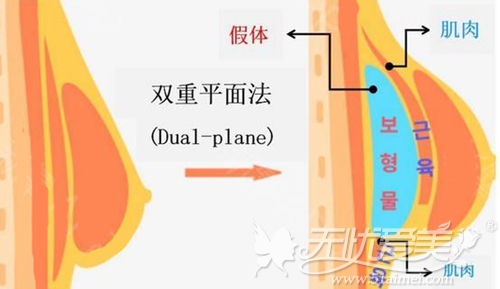 韩国双重平面法(Dual-plane)隆胸假体植入