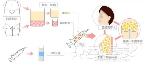 自体脂肪移植的过程