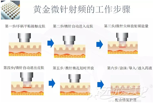 黄金微针除腋臭治疗过程