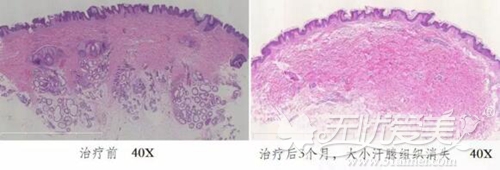 黄金微针除腋臭效果