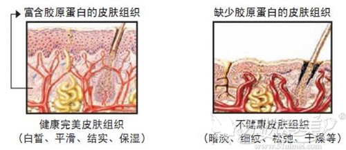 有无胶原蛋白的皮肤对比