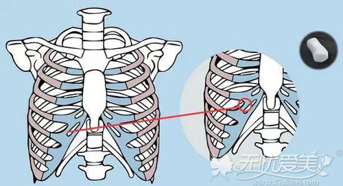 取自体肋软骨的位置