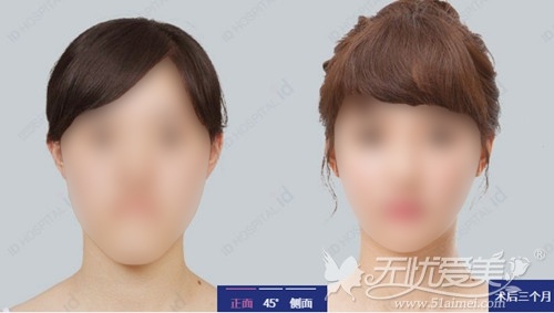 韩国ID整形医院面部轮廓三件套手术案例