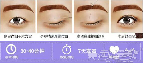 埋线法双眼皮原理