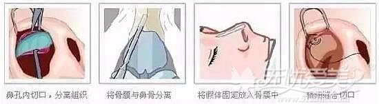 假体隆鼻手术原理