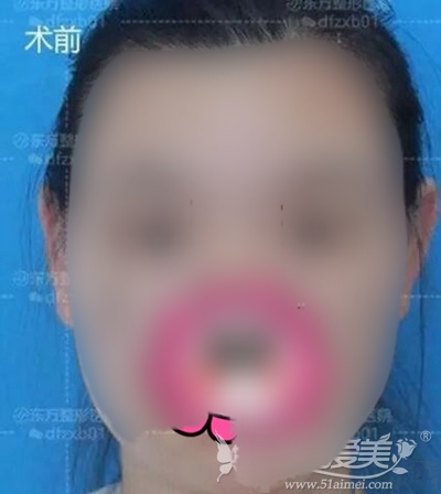内双宽眼距？妹子在郑州东方做眼综合手术后拥有翘睫美眼