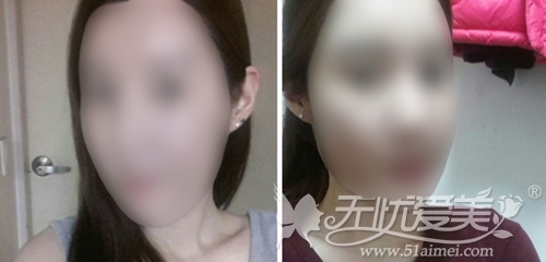 韩国face line面部轮廓+自体脂肪填充术前