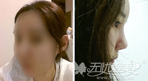 韩国face line面部轮廓+自体脂肪填充术后7天