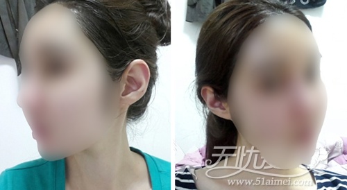 韩国face line面部轮廓+自体脂肪填充术后2周