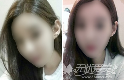 韩国face line面部轮廓+自体脂肪填充术后1个月