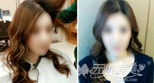 韩国face line面部轮廓+自体脂肪填充术后2个月