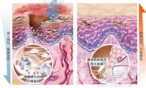 疤痕多技术联合诊疗