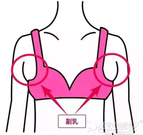 赘肉=副乳？不要想得太简单 了解区别后才知道该怎么办