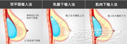 常见的假体隆胸手术方法