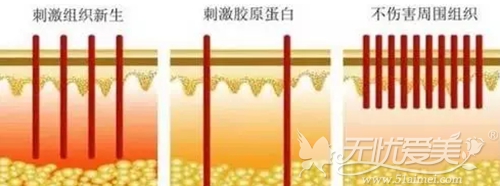皮秒镭射除皱原理