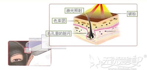 激光美白的作用原理