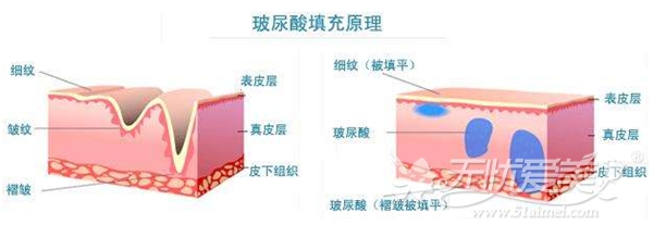 韩国5大面部除皱术 不动刀就能让你拥有童颜