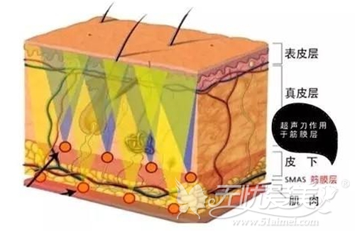 面部超声刀除皱原理