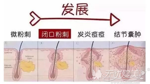 痘痘的发展过程